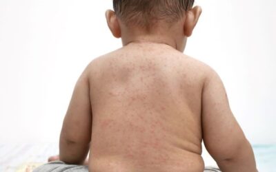 GLOBAL MEASLES CASES ARE ON THE RISE, WHAT IS THE ROOT CAUSE?