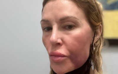 Brandi Glanville ‘wishes she knew’ what was wrong with her face as she shares medical theories